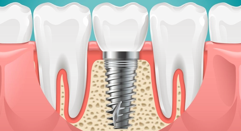 İmplant Tedavisi Acıtır mı?