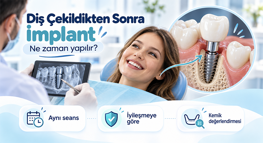 Diş Çekildikten Sonra İmplant Ne Zaman Yapılır?
